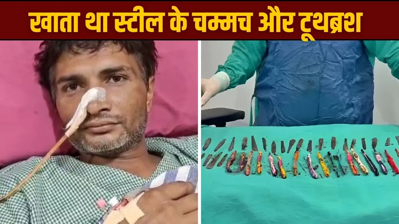 शरीर बना कब्रगाह! शख्स के पेट से निकले 29 चम्मच, 19 टूथब्रश और 2 पेन…
