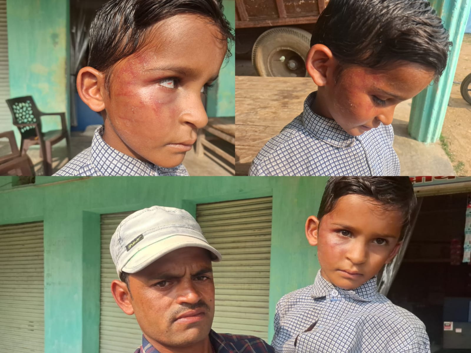 गिनती न सुना पाने पर शिक्षक का अत्याचार…दूसरी कक्षा के मासूम की आंख में उतरा खून…अधिकारियों ने दिए कार्रवाई के निर्देश…