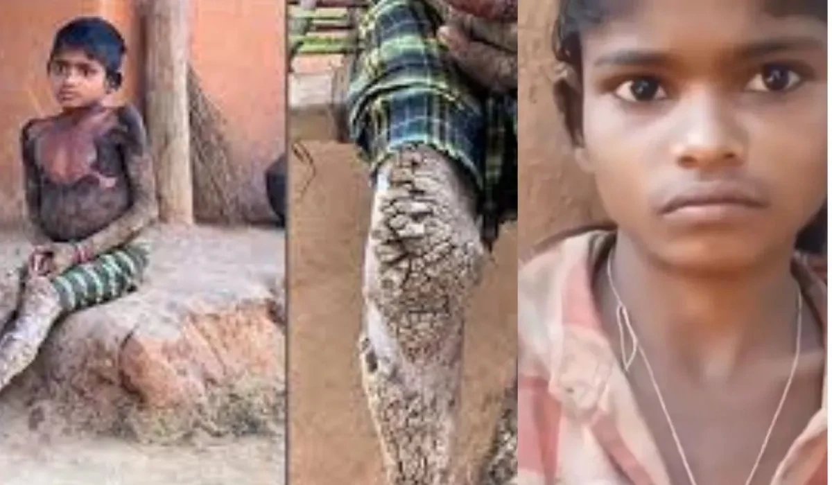 छत्तीसगढ़ के आदिवासी इलाके से सामने आया रोंगटे खड़े कर देने वाला मामला…पत्थर बनती जा रही 14 साल की मासूम…शरीर पर उग आई कांटेदार परत…कौन-सी है यह खौफनाक और दुर्लभ बीमारी?