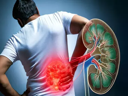 किडनी स्टोन से बचाव: आयुर्वेद से आसान उपाय