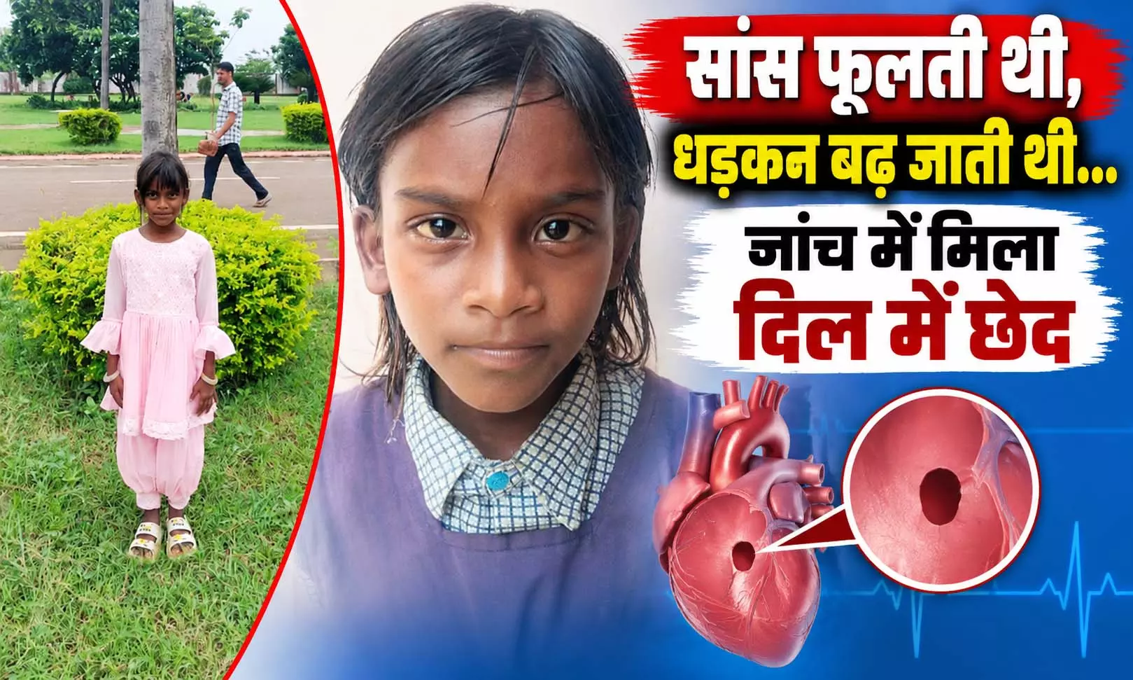 सांस फूलती थी, धड़कन तेज होती थी… जांच में दिल में निकला छेद, 8 साल की बच्ची का बिना ओपन हार्ट सर्जरी हुआ सफल इलाज